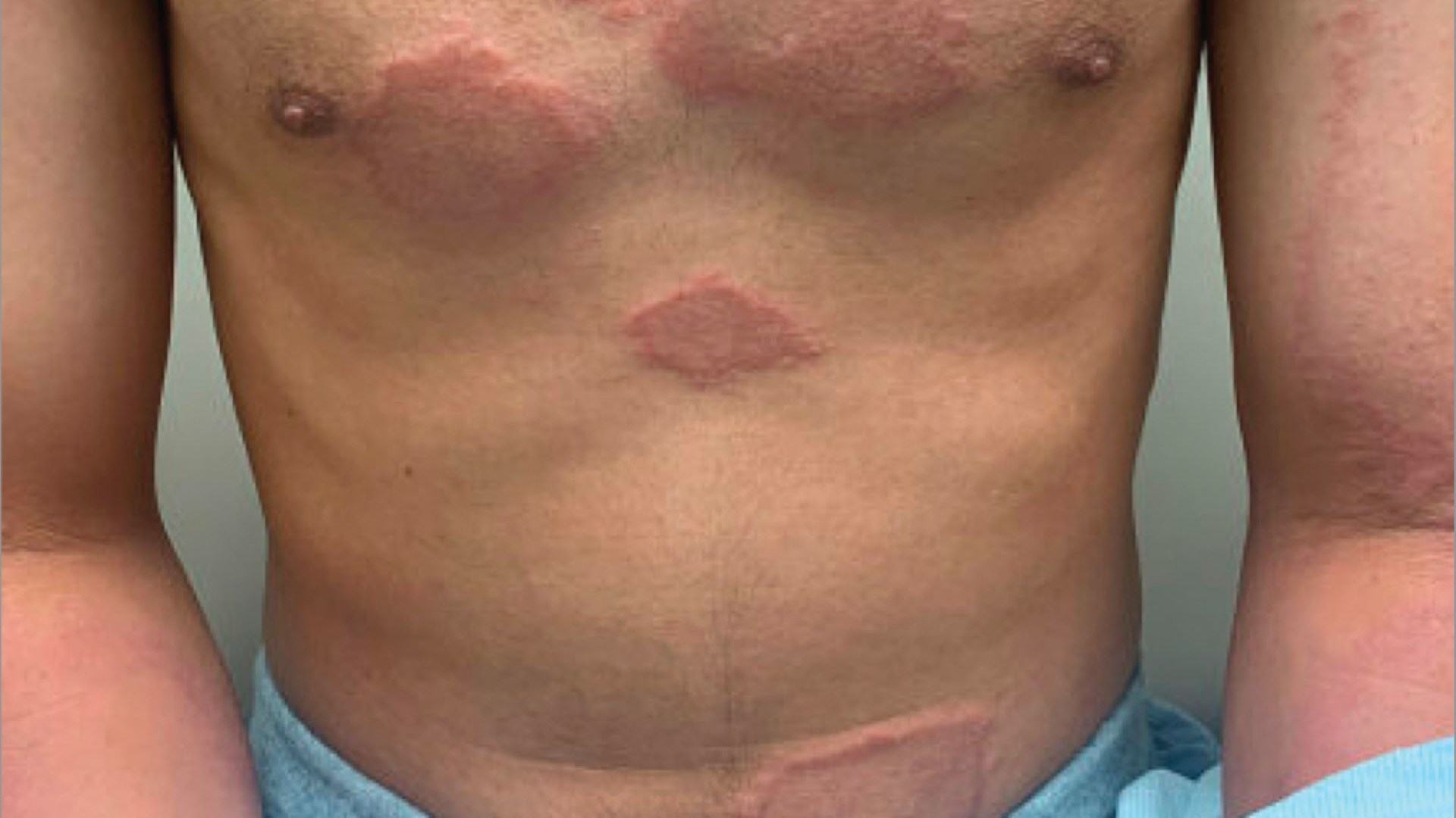 Doctors shocked to discover man's rash was actually a case of killer medieval disease